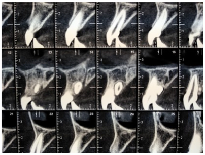 Denti sovrannumerari inclusi
